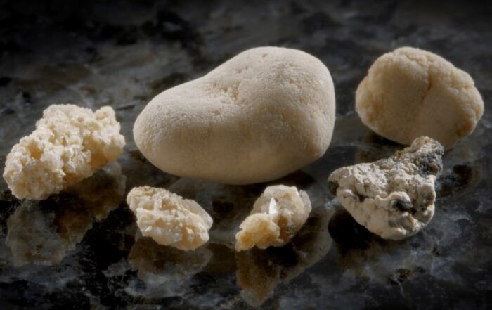 Kidney Stones