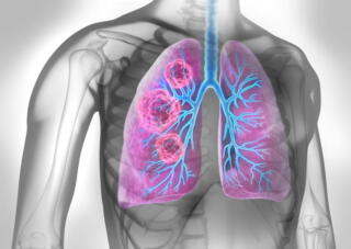 A 3D Rendering Of A Black And White Body With The Lungs Lit Up In Purple And Blue Showing Lung Cancer.