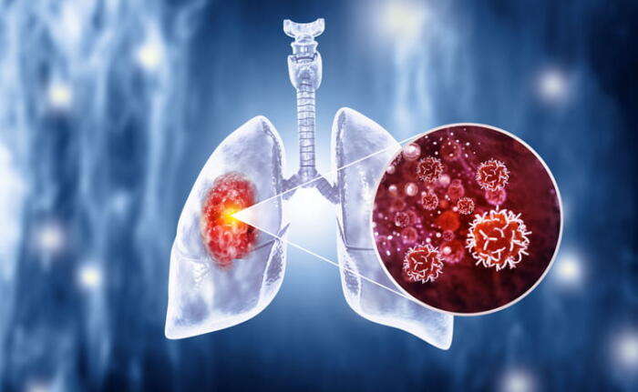 A Medical Illustration Showing Lung Cancer.